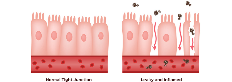 Enfermedad celiaca intestino delgado